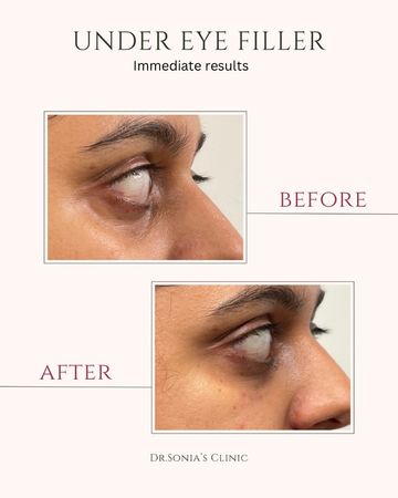 Under Eye Filler Before and After