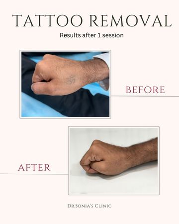 Tattoo Removal Before and After
