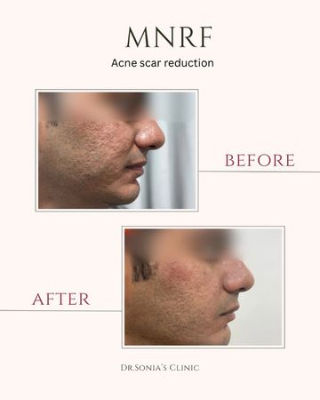 Acne Scar Reduction Before and After