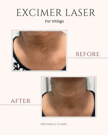 Vitiligo Treatment Before and After