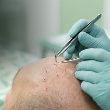 Hair follicles being implanted with forceps during a hair transplant