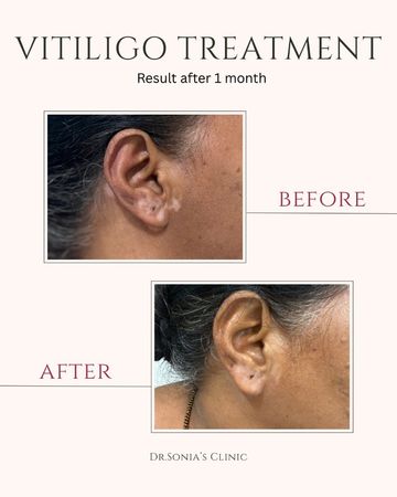 Vitiligo Ear Treatment Before and After